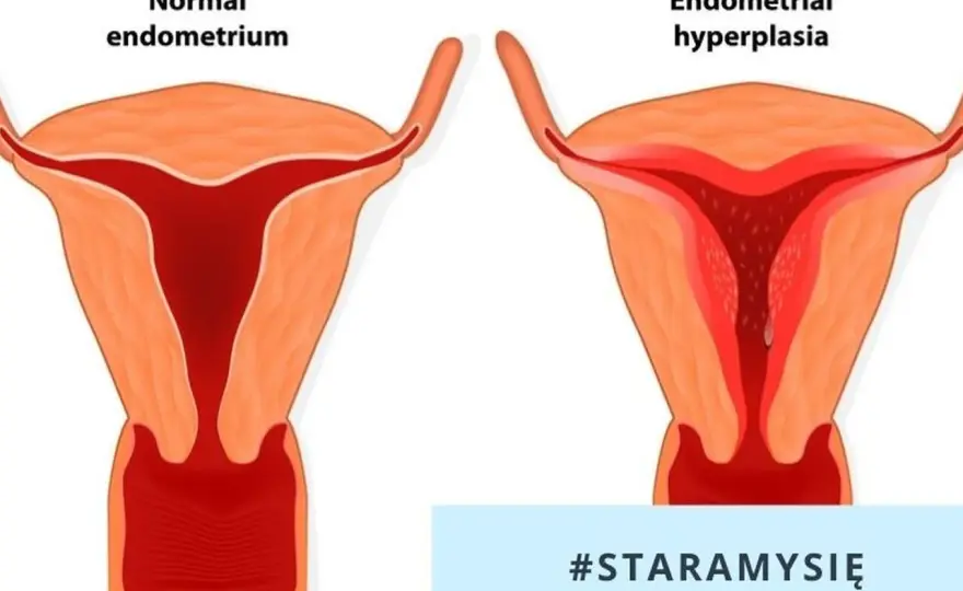 Przewlekłe zapalenie endometrium: objawy i metody leczenia.