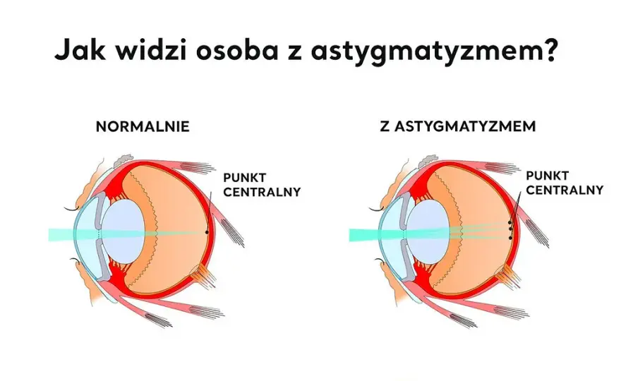 Cylindry w soczewkach: co to jest i jak wpływają na wzrok?