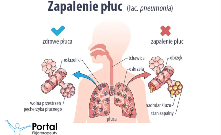 7 najgroźniejszych objawów zapalenia płuc, które musisz rozpoznać szybko