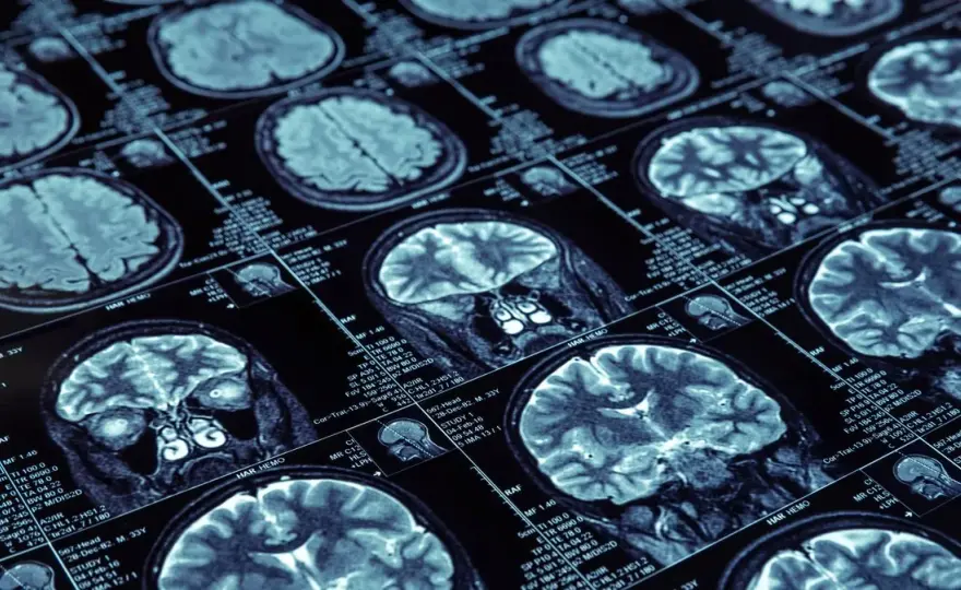 Jak zapobiec Alzheimerowi: Skuteczne metody na zmniejszenie ryzyka