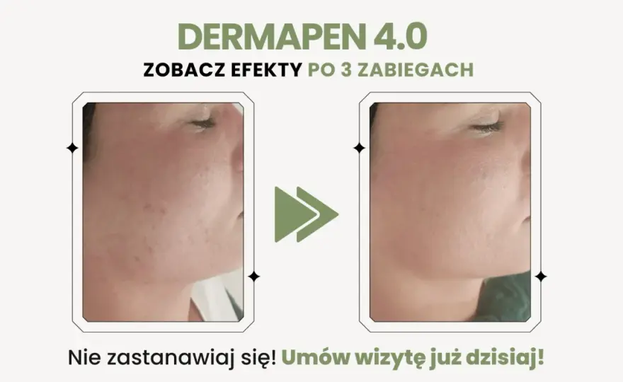 Dermapen efekty - Kiedy widać rezultaty i co daje seria?