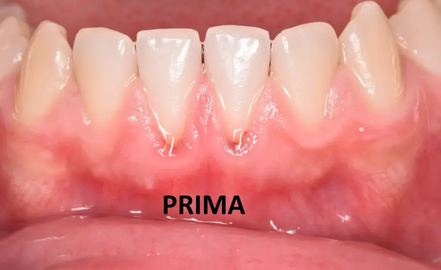 Gengive infiammate - Cosa fare e quando andare dal dentista