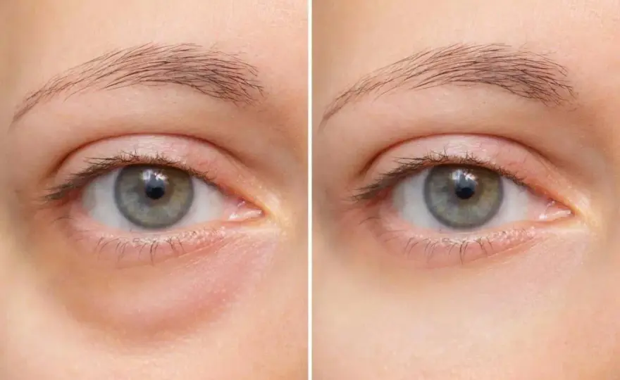 Augenringe entfernen - was wirklich hilft und wann zum Arzt?