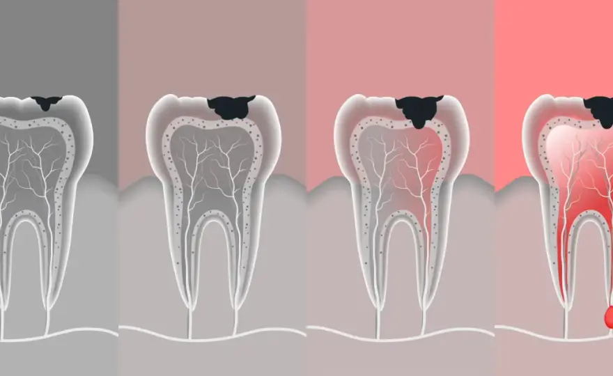¿Cómo es una caries? Fases, síntomas y tratamiento
