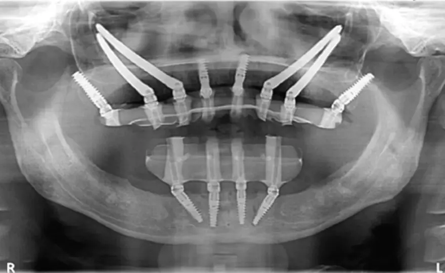 Impianti dentali senza osso - Soluzioni, costi e tempi reali