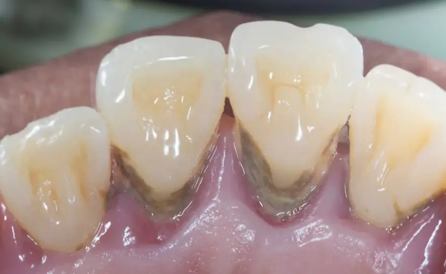 Parodontite - Gengive che sanguinano? Salva i tuoi denti!