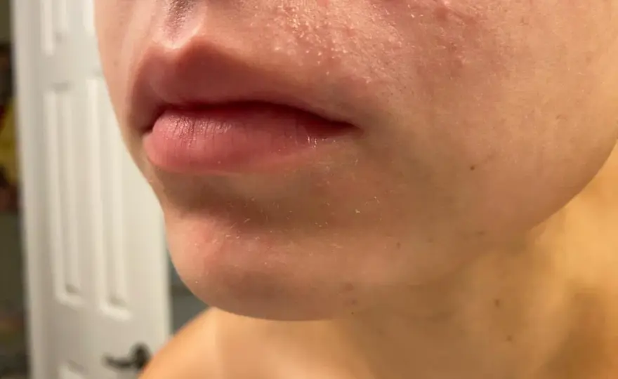 Elidel mot perioral dermatit - När det funkar & när det inte gör det