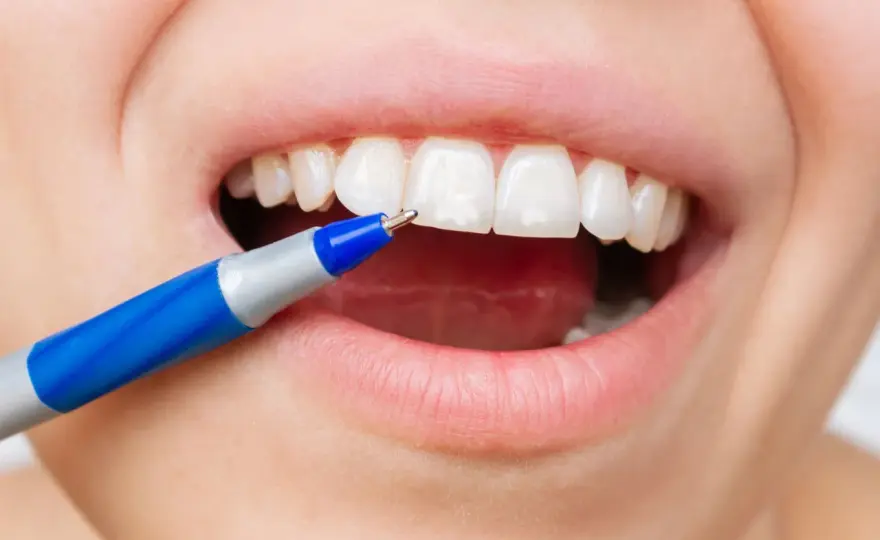 Fluoro per i denti, come usarlo senza errori