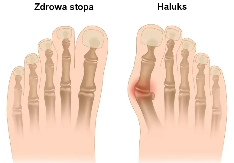 Ból haluksa: dlaczego stopa cierpi i jak znaleźć ulgę?