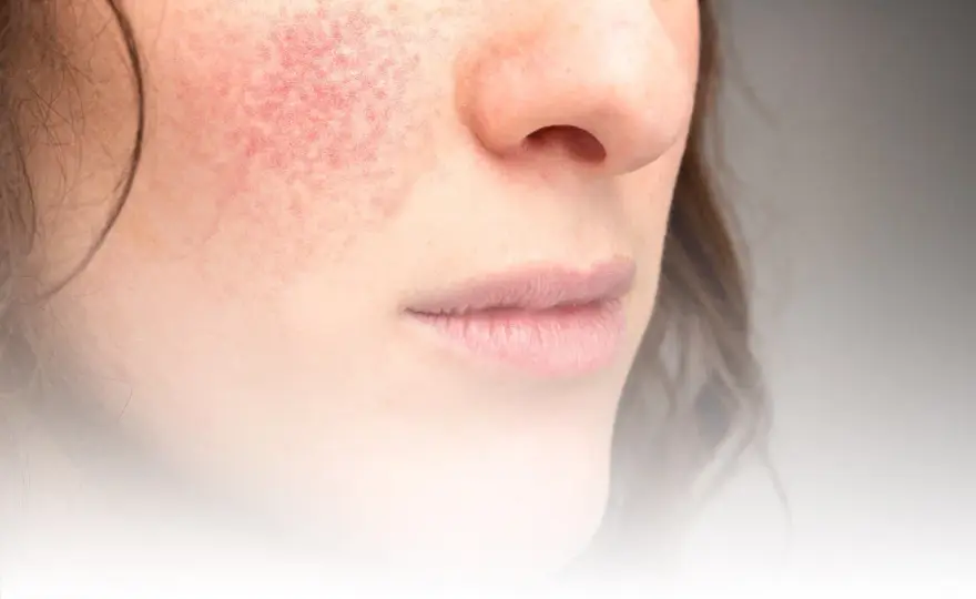 Behandla rosacea – så får du kontroll över rodnad och utslag