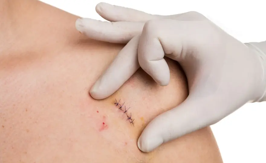 Retrait des points de suture - quand et comment ?