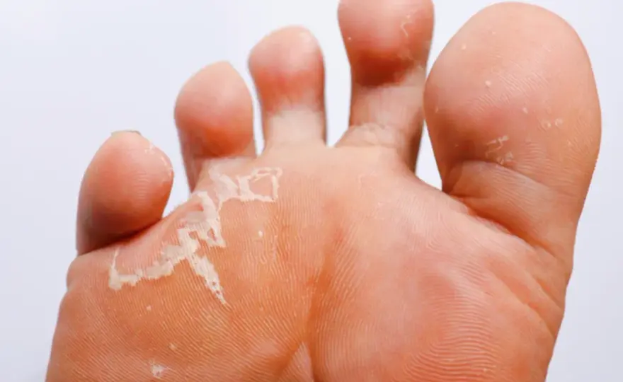 Pied d’athlète, quels signes et quel traitement choisir ?