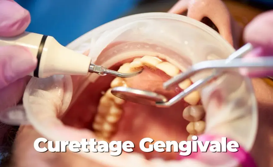 Pulizia sottogengivale - Guida completa: quando serve e come funziona