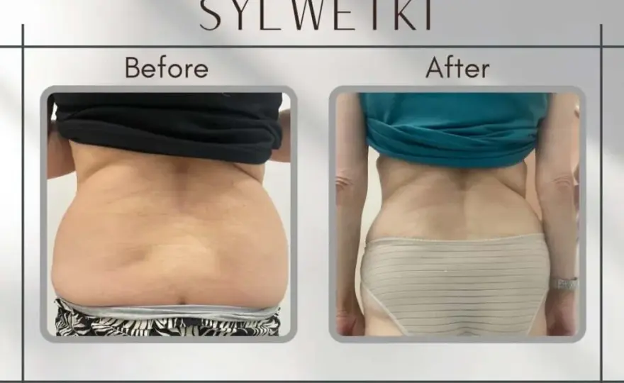 Liposukcja: co to? Modelowanie sylwetki, metody, ceny ekspert radzi
