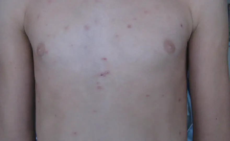 Pitiriasi lichenoide nei bambini - sintomi e cure