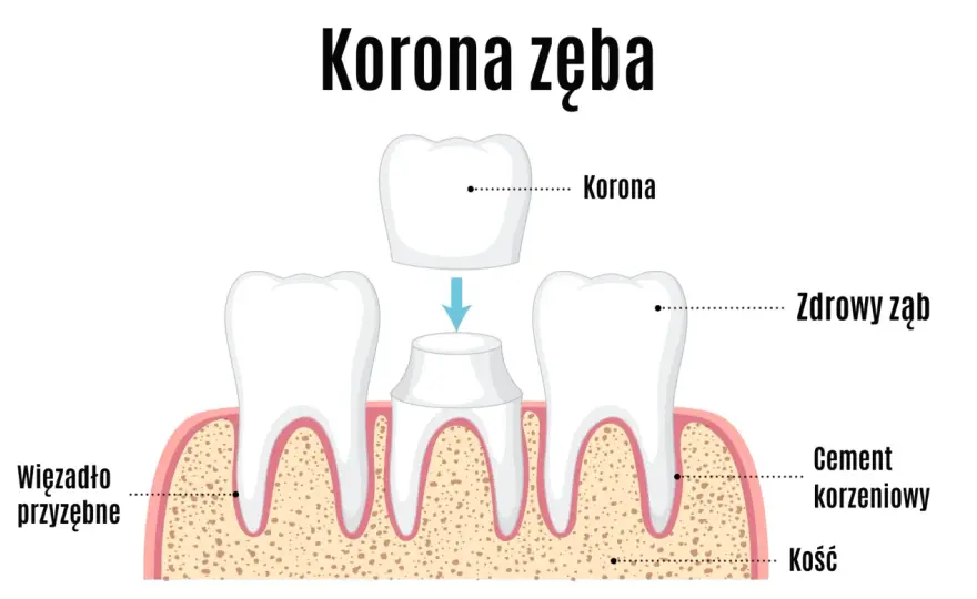 Tymczasowa korona na zębie - kiedy jest potrzebna i ile kosztuje