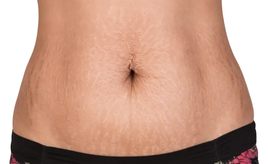 Mommy makeover efter graviditet - vad du behöver veta