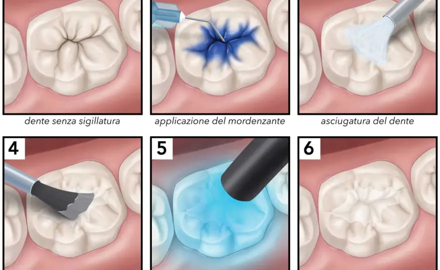 Solchi dentali e carie - quando serve la sigillatura