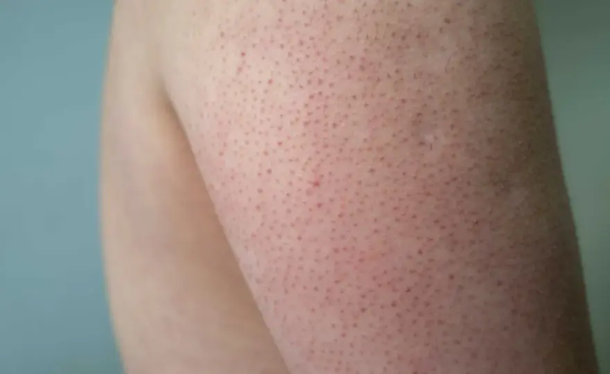 Knottrig hud hos barn - Keratosis pilaris: Lugna huden hemma