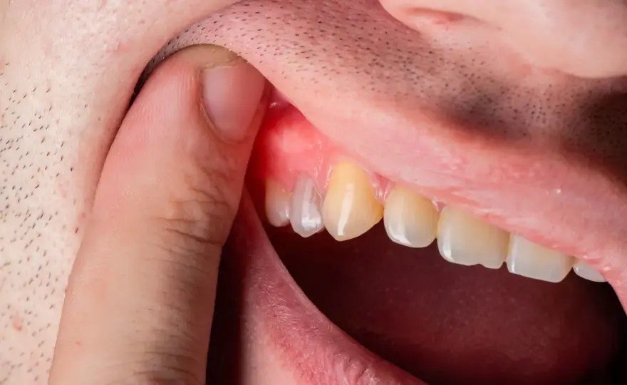 Ascesso dentale - Quanto dura davvero? Tempi e soluzioni