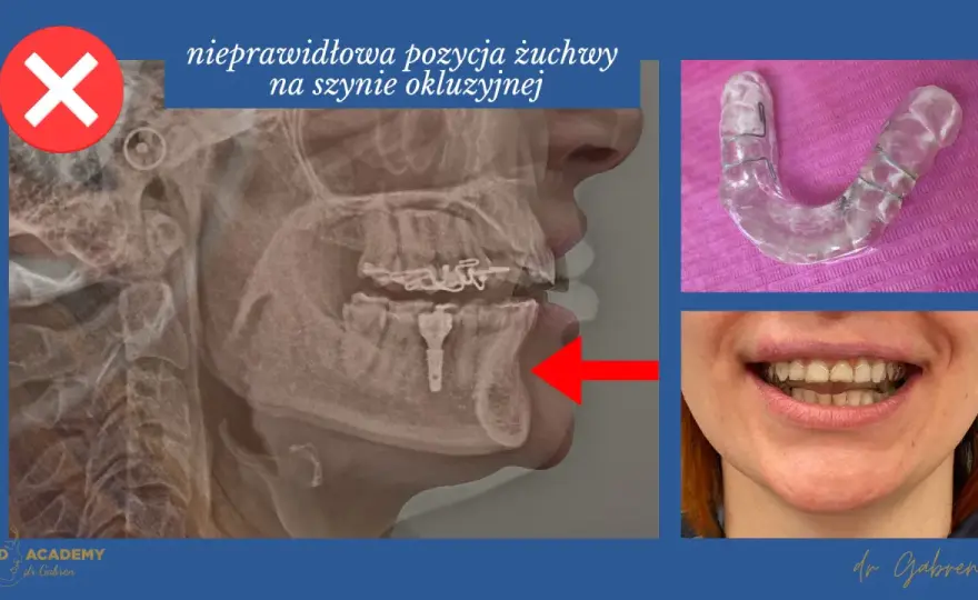 Szyna na żuchwę - Czy naprawdę działa na bruksizm?