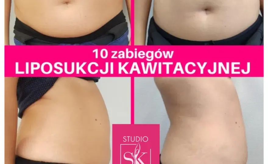 Ile zabiegów liposukcji kawitacyjnej? Odkryj swój plan!