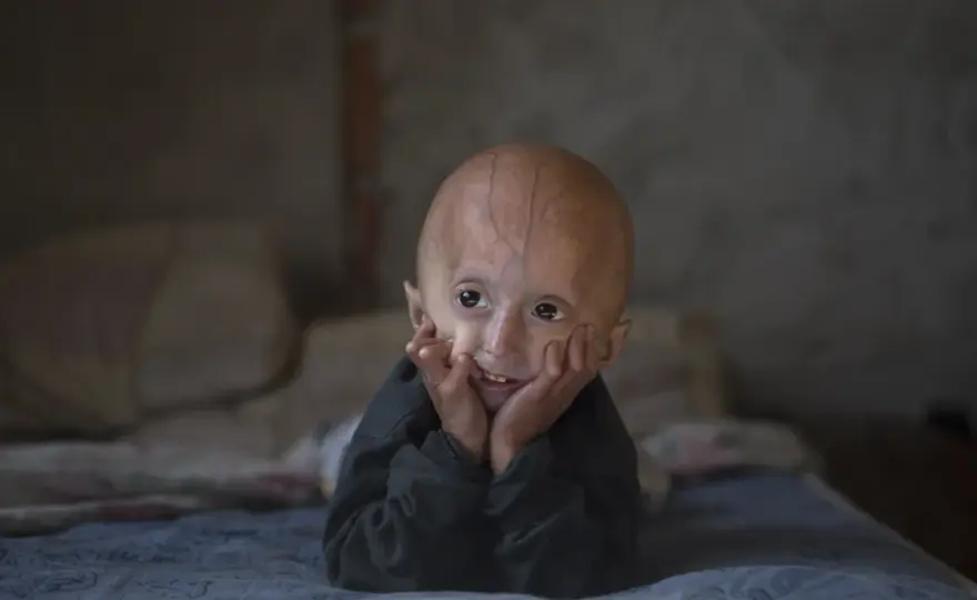 Progeria - Zespół Hutchinsona-Gilforda - objawy, diagnoza, opieka