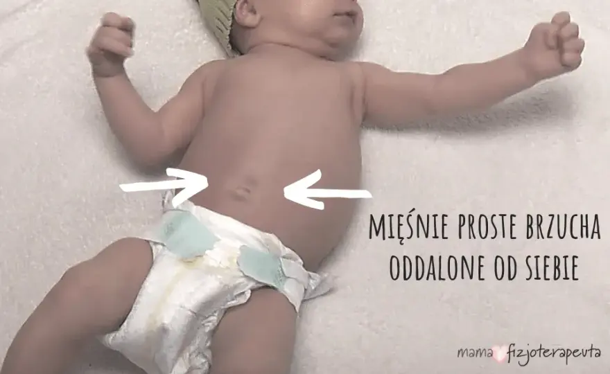 Rozejście mięśnia prostego brzucha u dziecka: objawy i leczenie.