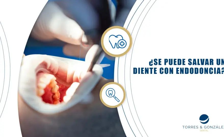 Endodoncia de un diente frontal ¿se puede salvar y se verá natural?