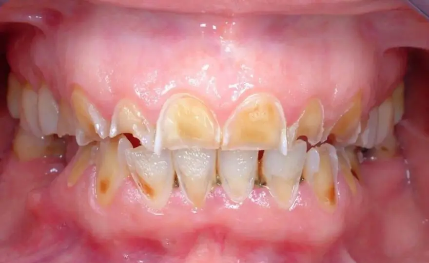 Anoressia e denti - i segnali da non ignorare e come proteggerli