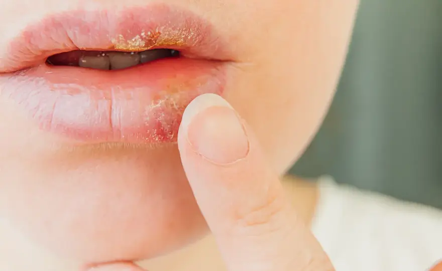 Herpes labial, cómo reconocerlo y cuándo consultar