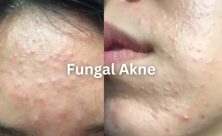 Fungal Akne - So erkennst & behandelst du sie richtig