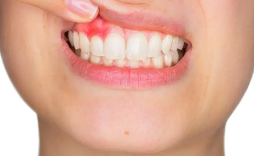 Periodontitis severa - cómo frenarla y conservar tus dientes