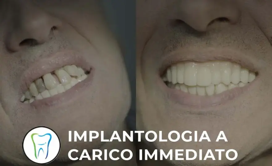 Controindicazioni dell’implantologia a carico immediato