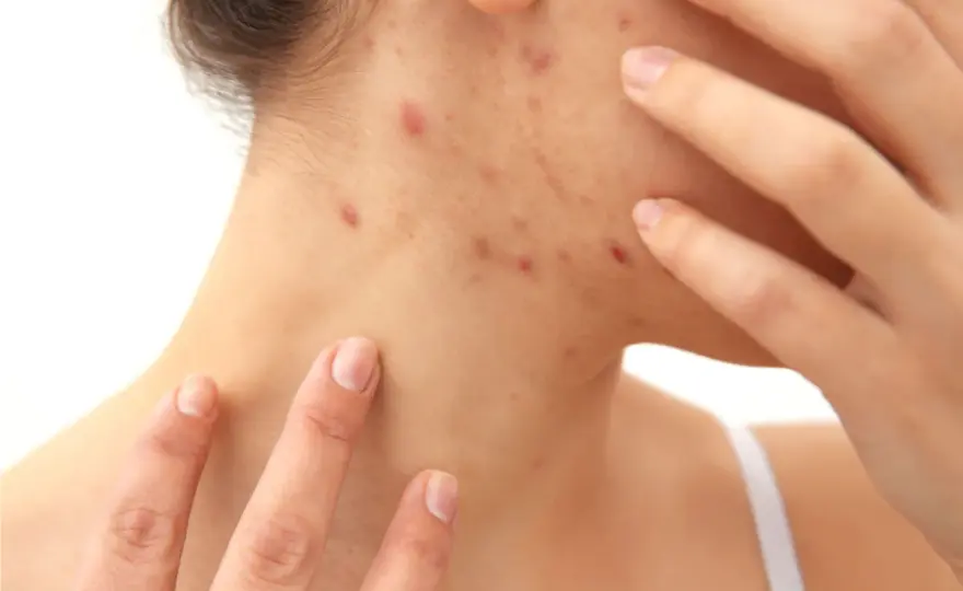 Pickel am Hals - Organe oder Hautproblem? Die Wahrheit!