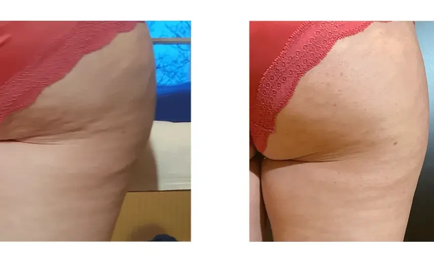 Endermologia: Redukcja cellulitu i modelowanie sylwetki czy to dla Ciebie?