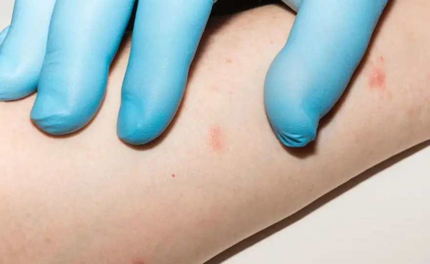 Psoriasi guttata nei bambini - come riconoscerla e curarla