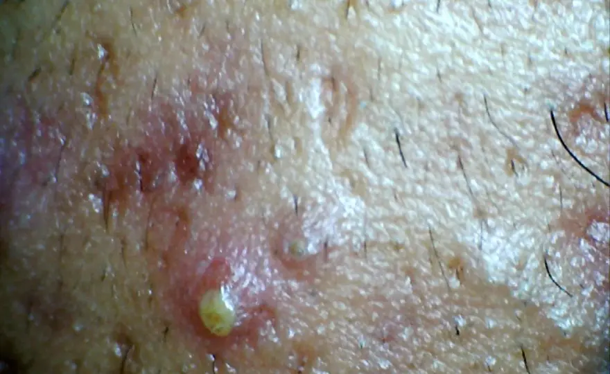 Pústulas en la piel - ¿Acné, infección o algo más?