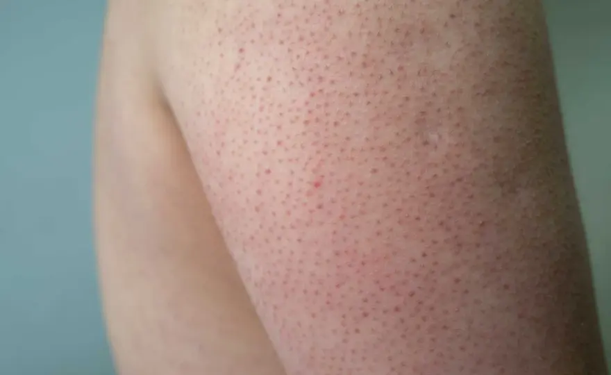 Knottror på kinderna? Så känner du igen keratosis pilaris