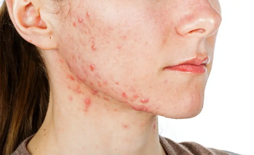 Acné légère, faut-il vraiment prendre du Roaccutane ?