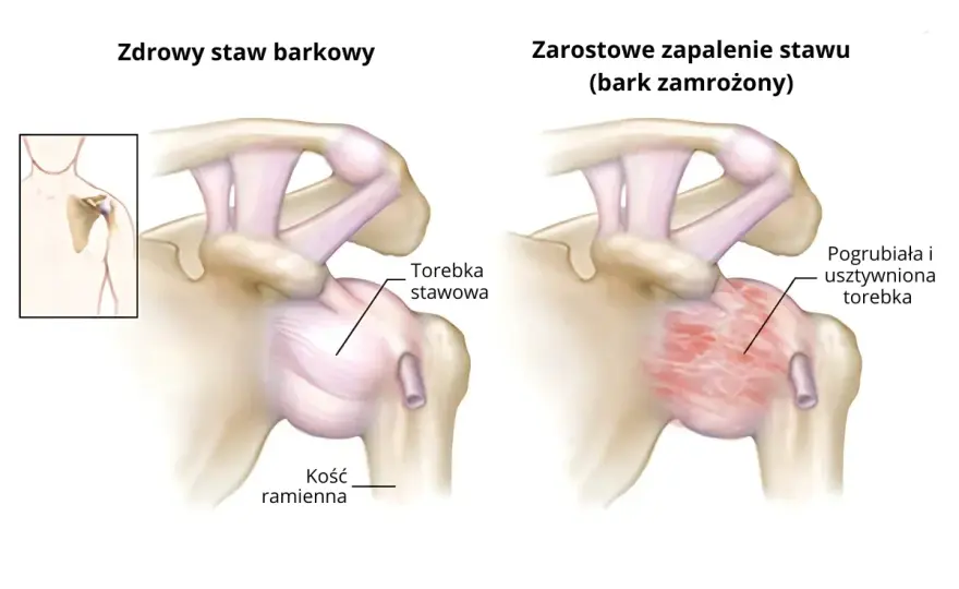Zapalenie mięśnia barkowego - Jak rozpoznać i skutecznie leczyć?