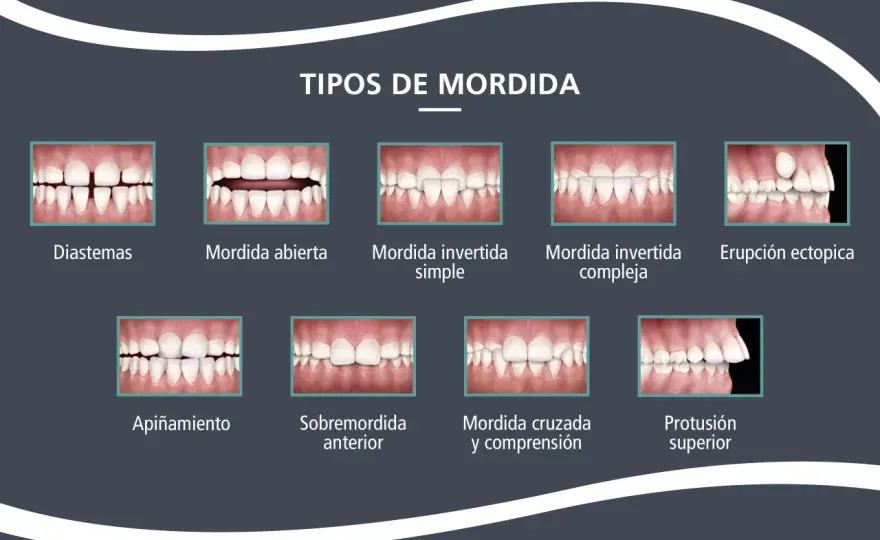 Mordida abierta - causas, tratamiento y cómo corregirla