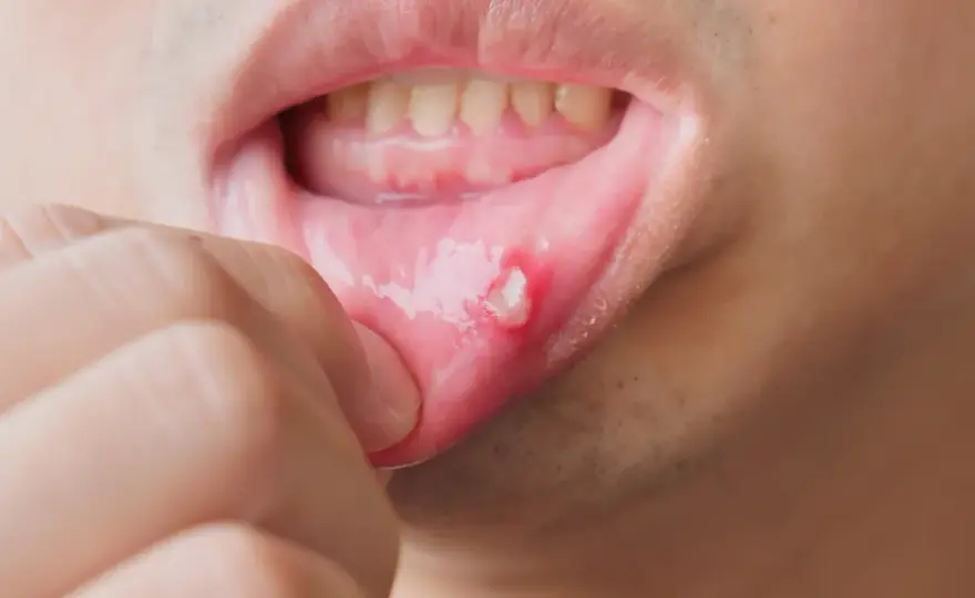 Masz opryszczkę? Dentysta odmówi! Co robić i kiedy iść?