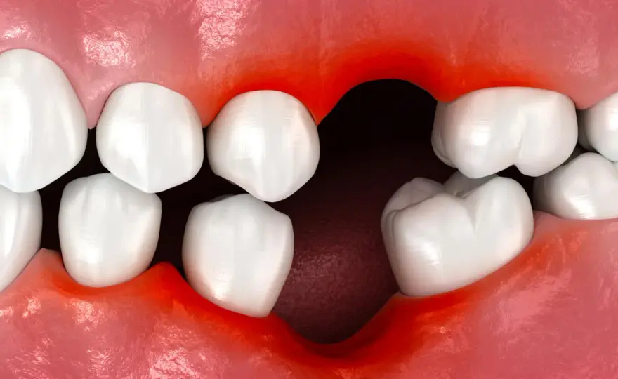 Suchy zębodół - objawy, leczenie, kiedy do dentysty?