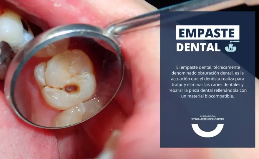 Empaste dental en una muela - cuándo basta y cuánto cuesta