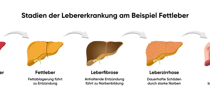Fettleber Symptome erkennen und gezielt gegensteuern