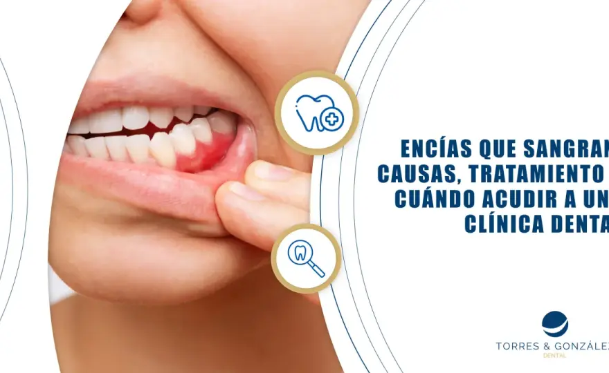 ¿Por qué sangran las encías? Causas y cuándo acudir al dentista