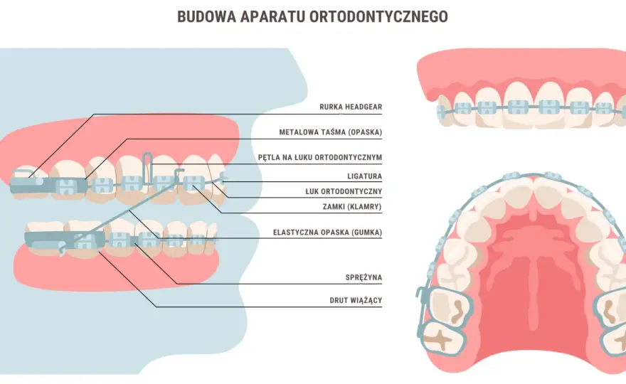 Aparat ortodontyczny: Ile trwa założenie i jak się przygotować?