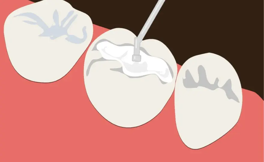 Dientes sensibles al frío - causas y cuándo necesitas un empaste
