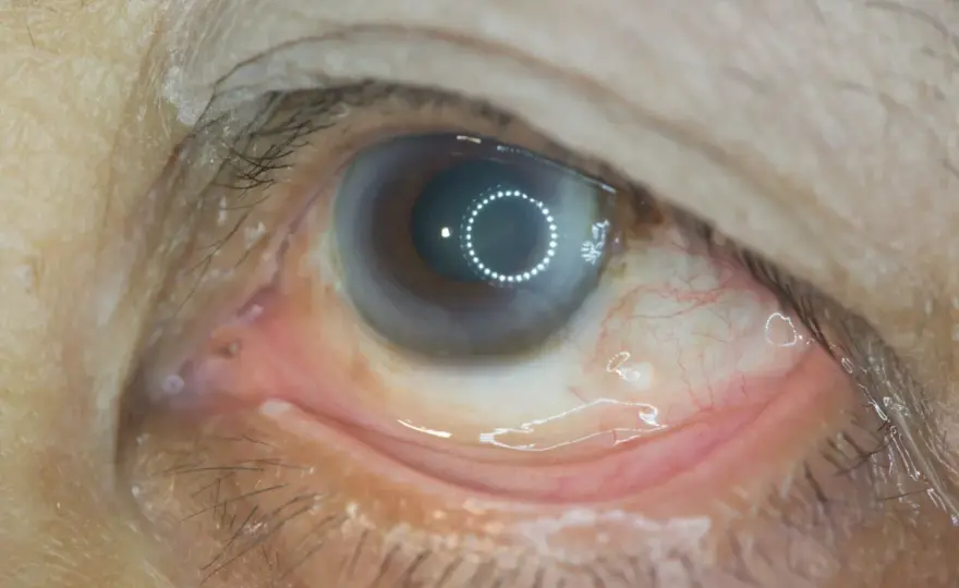 Retinopatia cukrzycowa - Jak rozpoznać objawy i chronić wzrok?